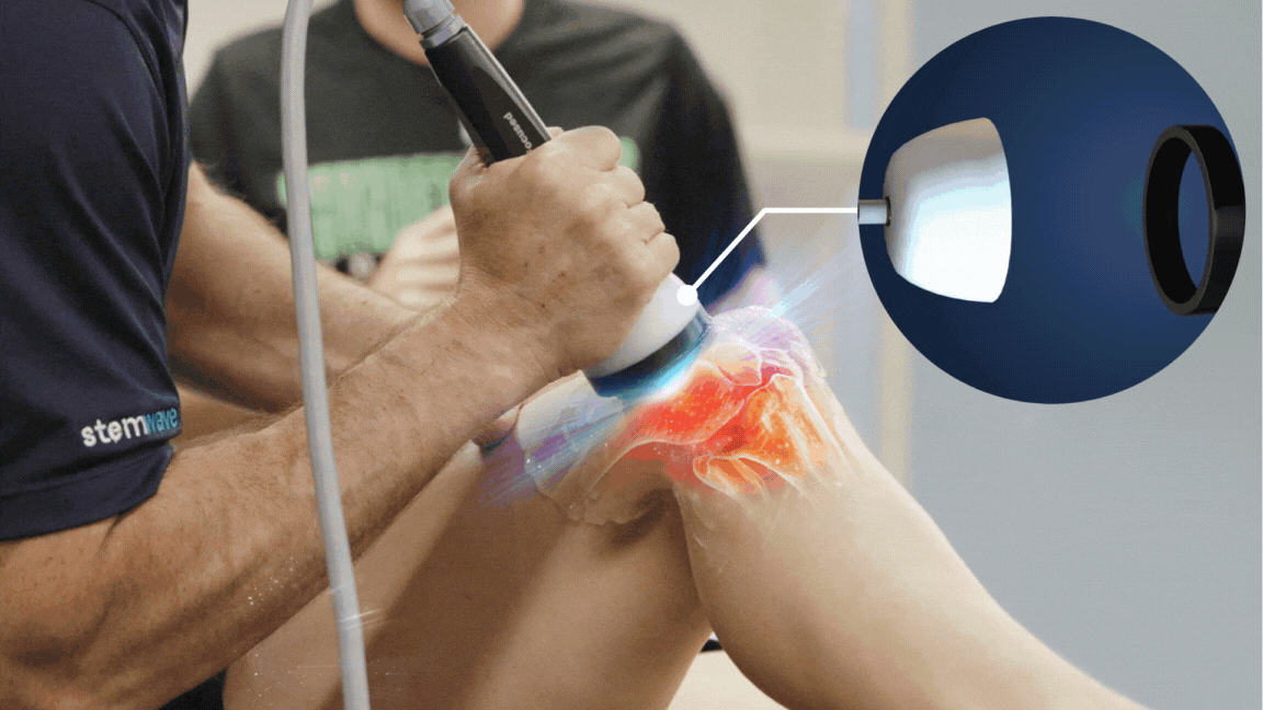 Animated image of stemwave therapy on knee